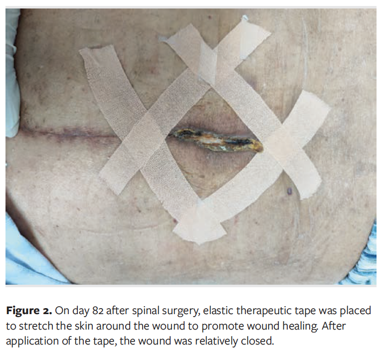 Therapeutic Taping to Offload Wound Margin Strain and as an Adjunct to